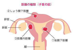 切らない筋腫治療センター筋腫の種類（子宮の図）