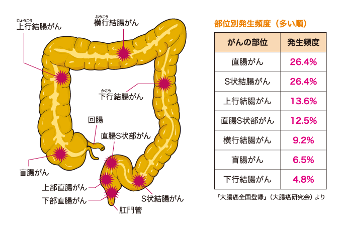 大腸の構造とがんのできやすい部位