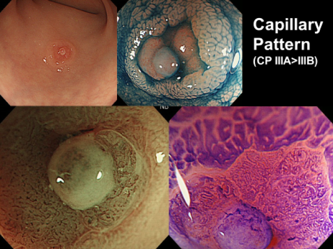 院長が開発した内視鏡診断機器（ＮＢＩ）による大腸早期がん