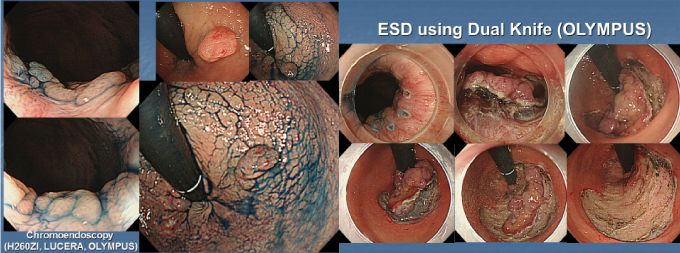 早期がんの内視鏡治療（ＥＳＤ）従来は手術が必要であった病変も内視鏡で治療が可能になっています。