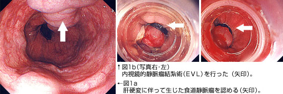 内視鏡的静脈瘤結紮術