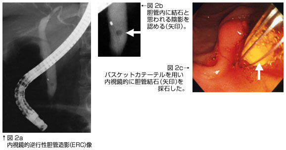 内視鏡的逆行性胆道膵管造影