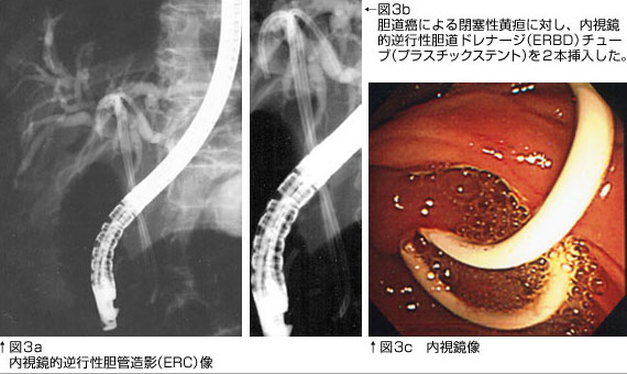 内視鏡的逆行性胆道膵管造影