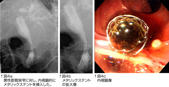 悪性胆管狭窄に対し内視鏡にメタリックステント挿入