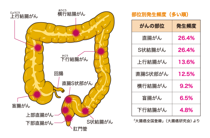 癌 s 状 結腸 Ｓ状結腸癌｜所沢 医療法人元気会