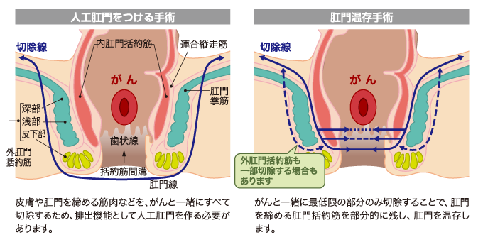 肛門温存手術の図