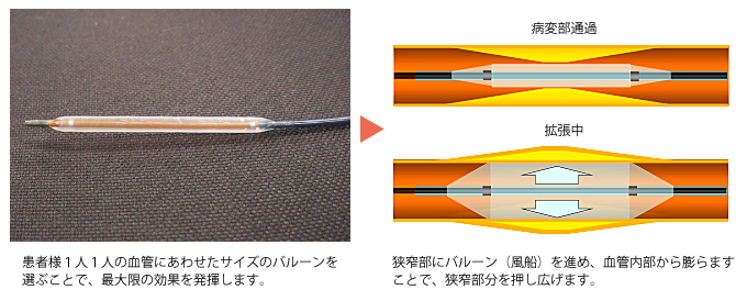 Pta シャント